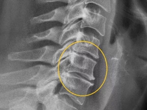 Остеохондроза на шийния гръбначен стълб върху x -ray